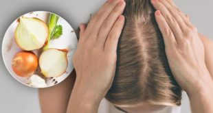 Нанесение сока сырого лука на кожу головы уменьшает выпадение волос